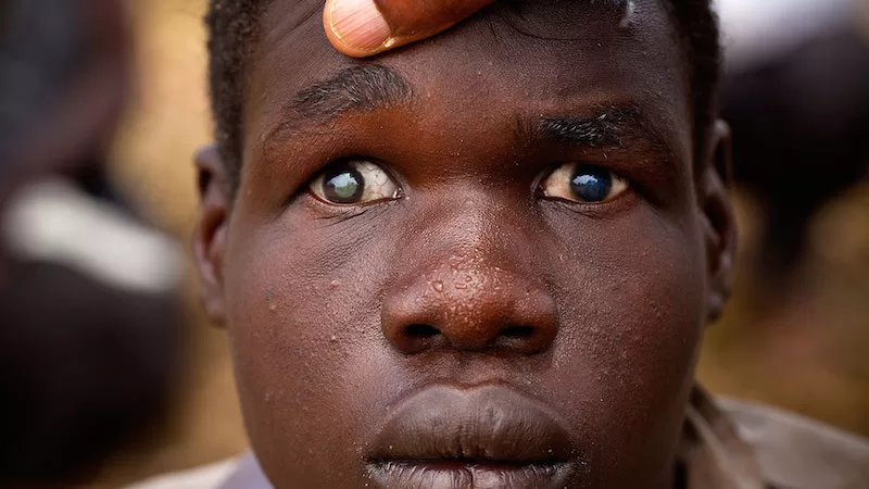 23 MILLION NIGERIANS SUFFER SUFFER FROM EYE PROBLEMS – EXPERT 1 eye problems 1